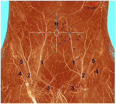 Frontiers Strategies For Selecting Perforator Vessels For Transverse